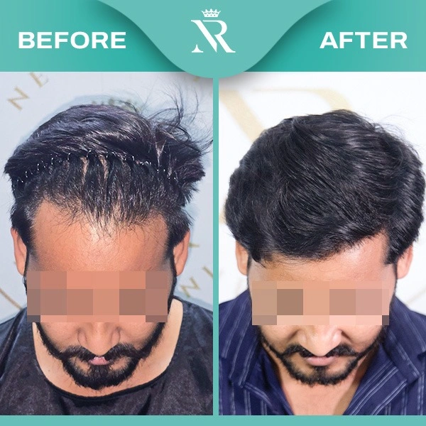 No Shave Hair Transplant