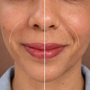 Nasolabial fold filler