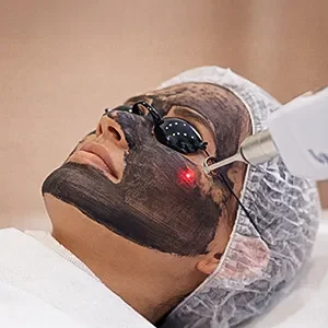 Carbon Peel Laser